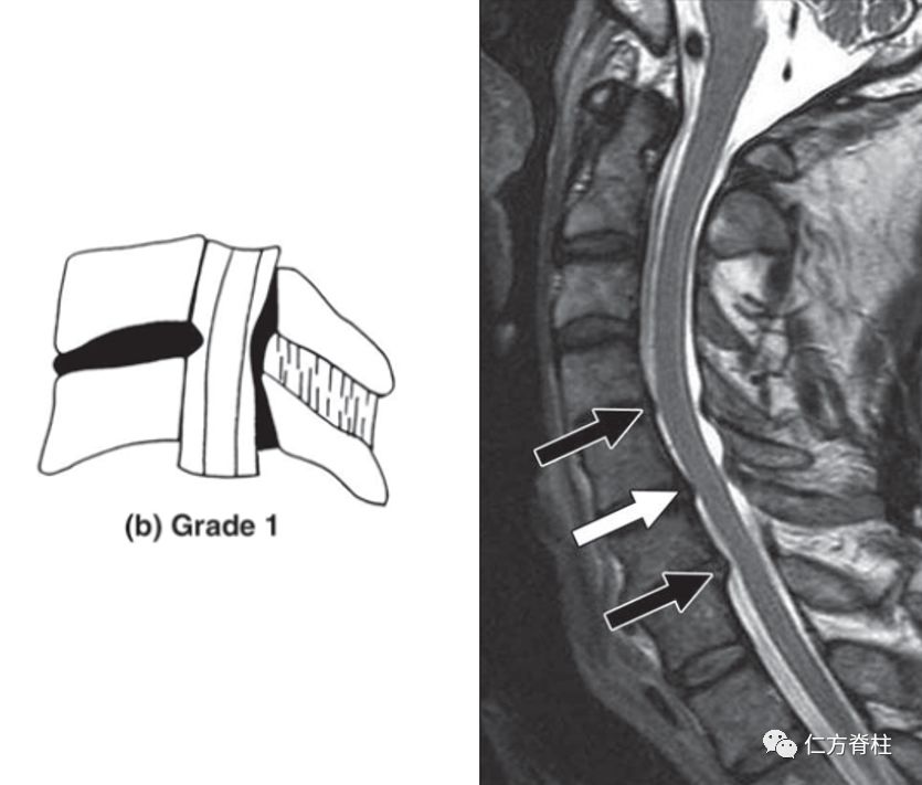 頸椎椎管狹窄的新型mri分級系統