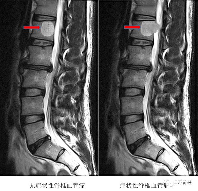 脊椎血管瘤需要手术吗 椎管内肿瘤 手术