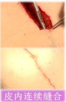 倒刺线怎么缝合TA的名字：倒刺线_https://www.jmylbn.com_新闻资讯_第25张