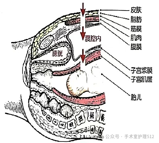 产包有什么器械子宫下段剖宫产术的手术配合_https://www.jmylbn.com_新闻资讯_第8张