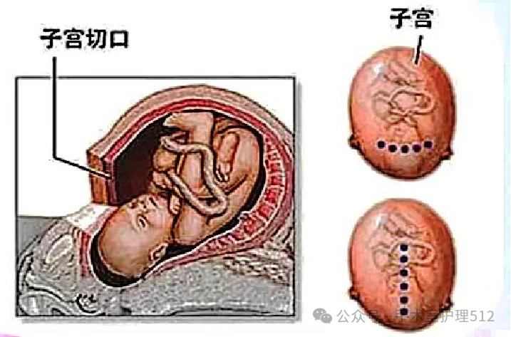 产包有什么器械子宫下段剖宫产术的手术配合_https://www.jmylbn.com_新闻资讯_第9张