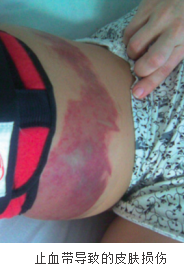 手术中怎么止血止血带在骨科手术中的应用_https://www.jmylbn.com_新闻资讯_第7张