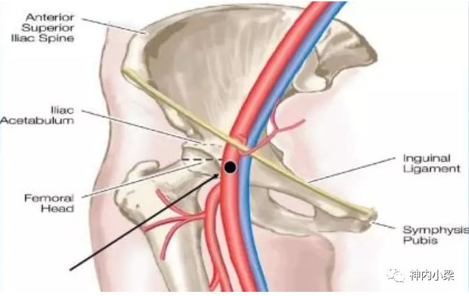 动脉长鞘怎么置入神经介入第一站：股动脉穿刺_https://www.jmylbn.com_新闻资讯_第1张