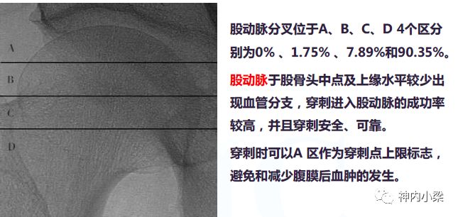 动脉长鞘怎么置入神经介入第一站：股动脉穿刺_https://www.jmylbn.com_新闻资讯_第6张