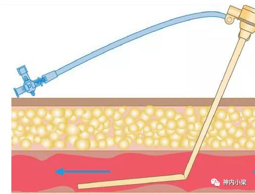 动脉长鞘怎么置入神经介入第一站：股动脉穿刺_https://www.jmylbn.com_新闻资讯_第19张
