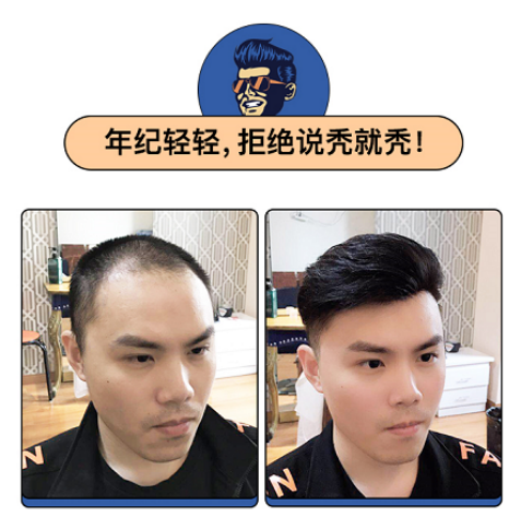 有什么方法可以拯救发际线吗？——织发补发