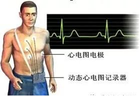 动态心电图仪器怎么看心脏不舒服，心电图显示没问题？动态心电图了解一下_https://www.jmylbn.com_新闻资讯_第6张
