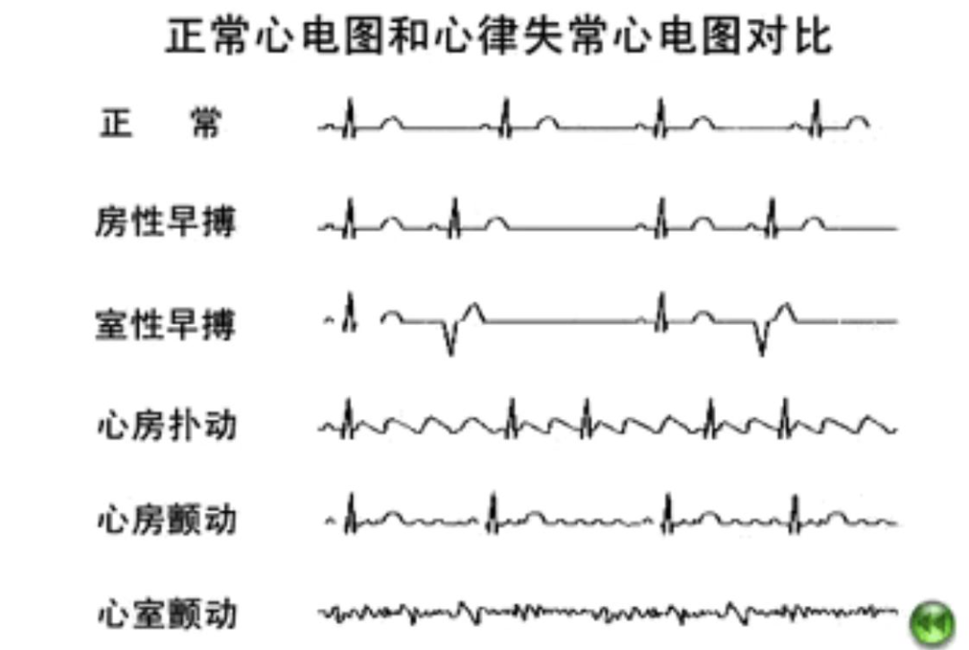 动态心电图仪器怎么看心脏不舒服，心电图显示没问题？动态心电图了解一下_https://www.jmylbn.com_新闻资讯_第5张
