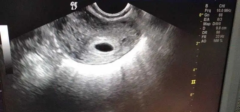 你只羡慕人家儿女双全，但却不知保胎背后的艰辛！