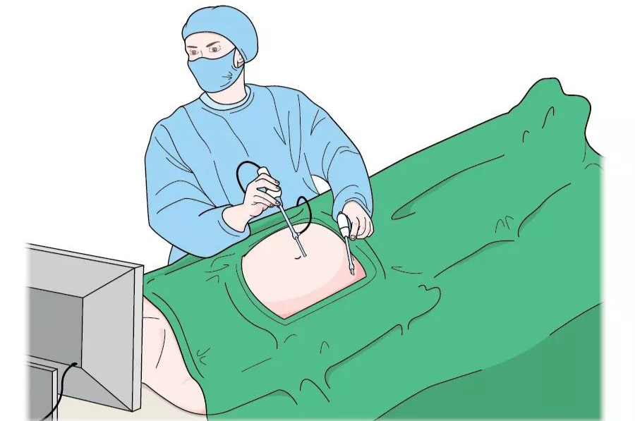 卵巢“巧克力囊肿”合并不孕，做手术还是试管?