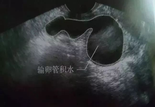 试管知识 | “鹊桥”积水也会影响试管成功率！