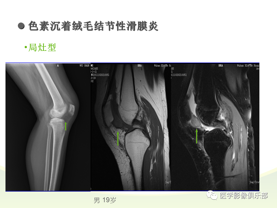 膝关节滑膜病变mri表现_医学界-助力医生临床决策和职业成长