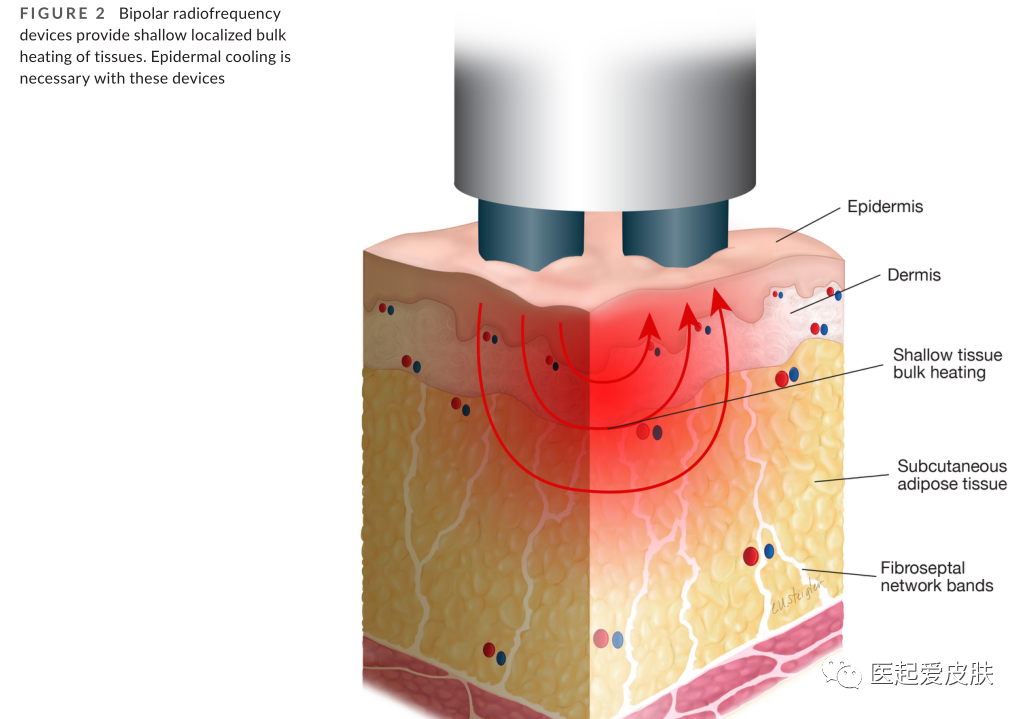 多极射频是什么射频治疗在美容皮肤科的介绍与综述_https://www.jmylbn.com_新闻资讯_第3张