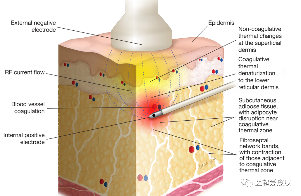 多极射频是什么射频治疗在美容皮肤科的介绍与综述_https://www.jmylbn.com_新闻资讯_第7张