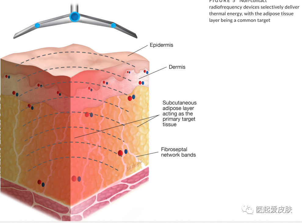 多极射频是什么射频治疗在美容皮肤科的介绍与综述_https://www.jmylbn.com_新闻资讯_第6张