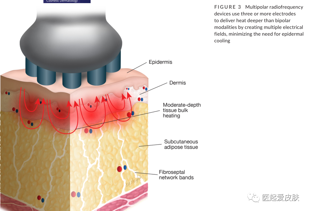 多极射频是什么射频治疗在美容皮肤科的介绍与综述_https://www.jmylbn.com_新闻资讯_第4张