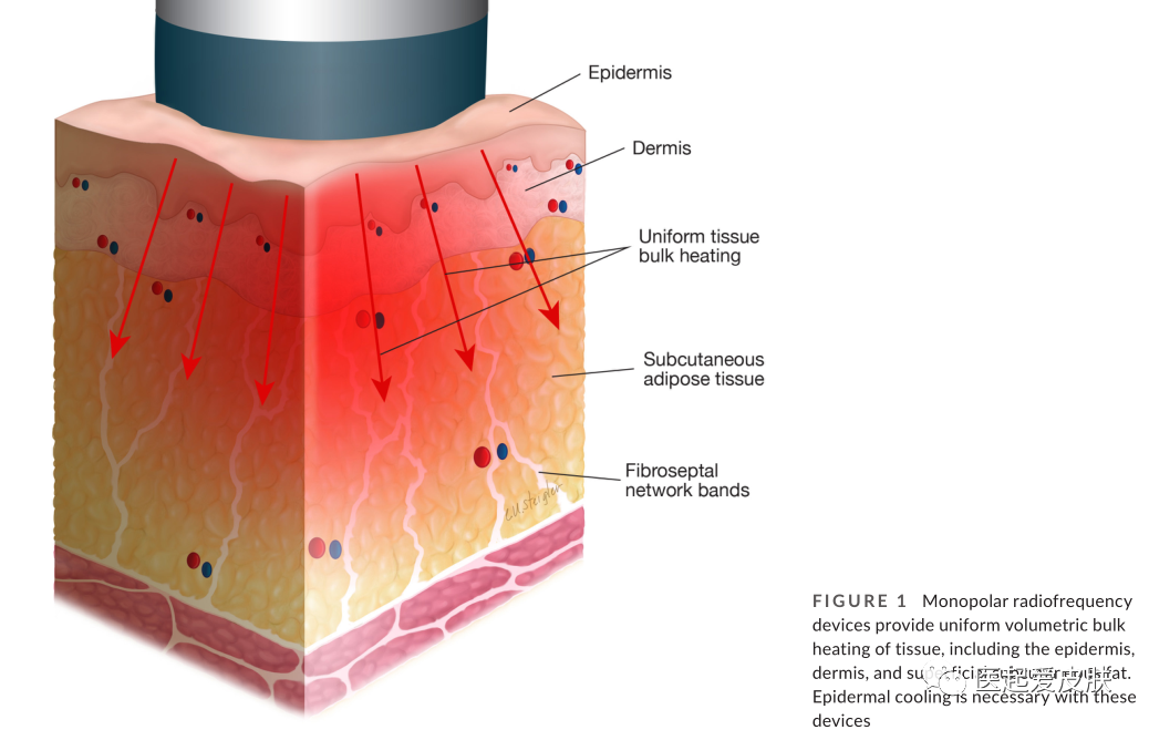 多极射频是什么射频治疗在美容皮肤科的介绍与综述_https://www.jmylbn.com_新闻资讯_第2张