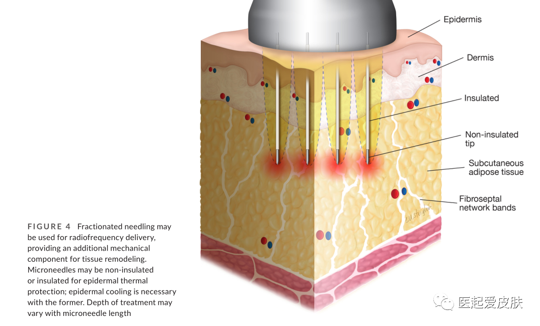多极射频是什么射频治疗在美容皮肤科的介绍与综述_https://www.jmylbn.com_新闻资讯_第5张