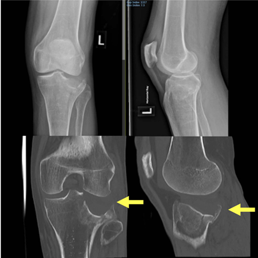 胫骨平台后外侧骨折的手术入路及治疗策略汇总