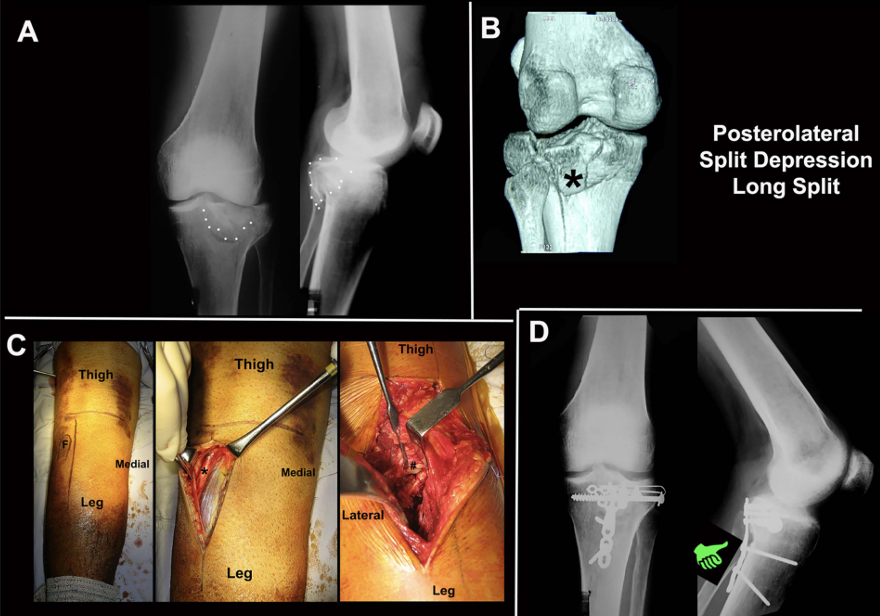 胫骨平台后外侧骨折的手术入路及治疗策略汇总