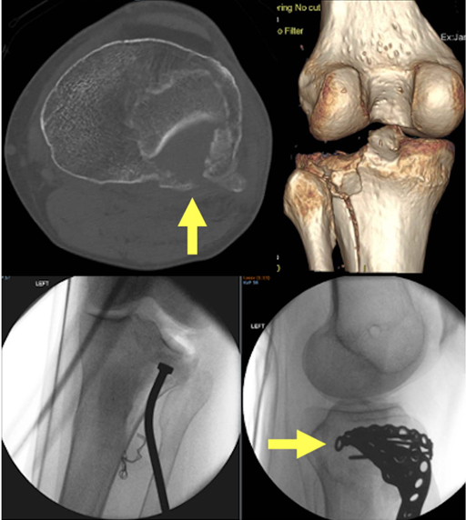 胫骨平台后外侧骨折的手术入路及治疗策略汇总