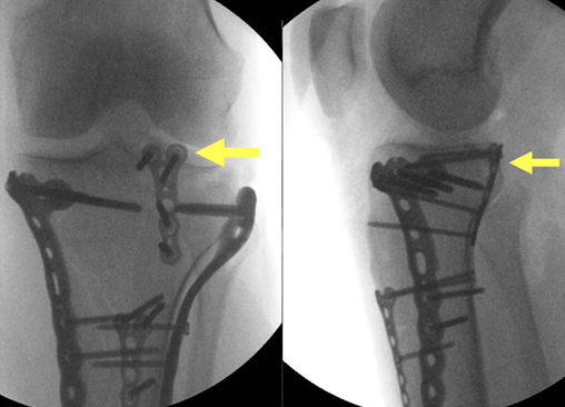 胫骨平台后外侧骨折的手术入路及治疗策略汇总