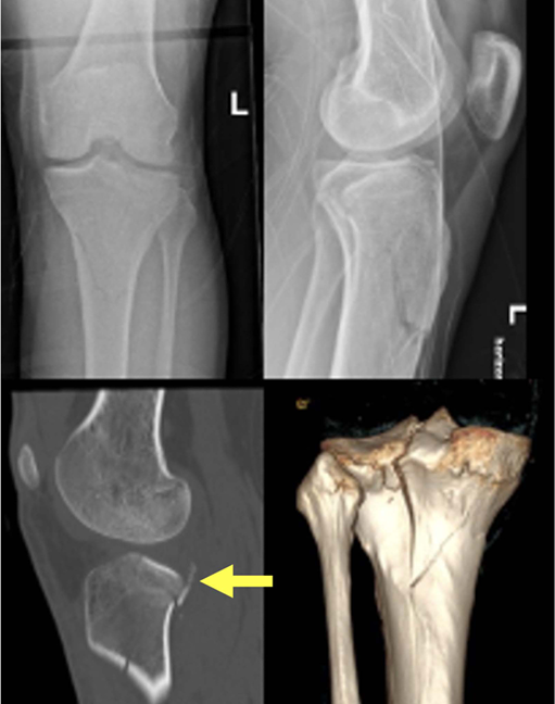 胫骨平台后外侧骨折的手术入路及治疗策略汇总