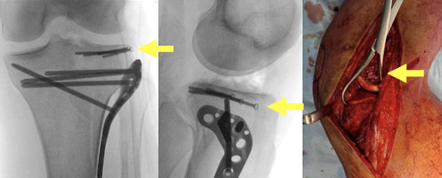 胫骨平台后外侧骨折的手术入路及治疗策略汇总