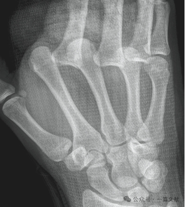 掌骨骨折、脱位影像汇总