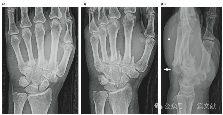 掌骨骨折、脱位影像汇总