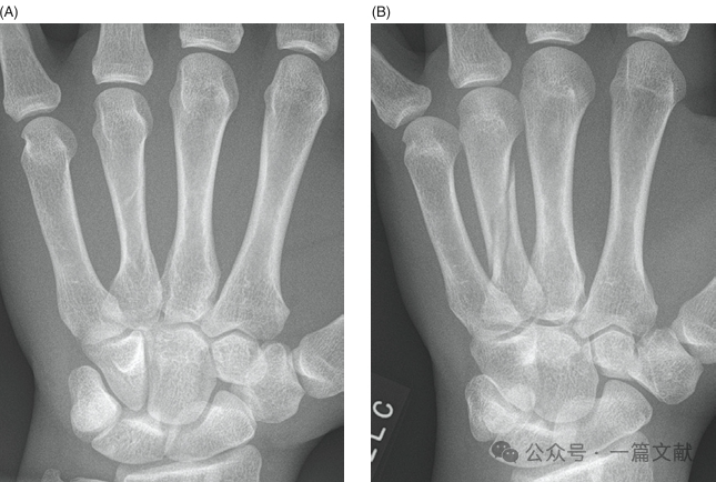 掌骨骨折、脱位影像汇总