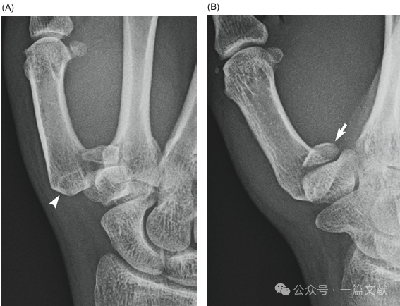 掌骨骨折、脱位影像汇总