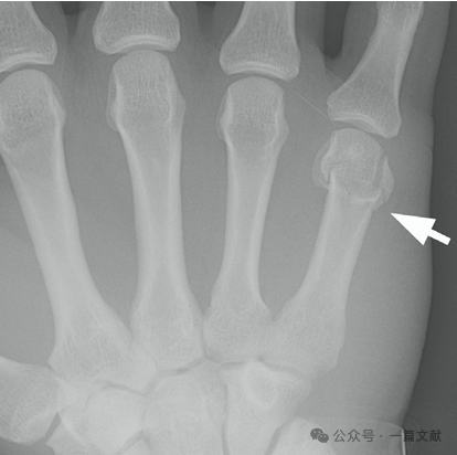 掌骨骨折、脱位影像汇总