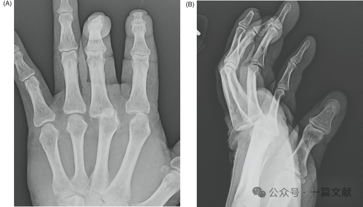 掌骨骨折、脱位影像汇总