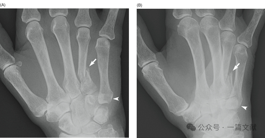 掌骨骨折、脱位影像汇总