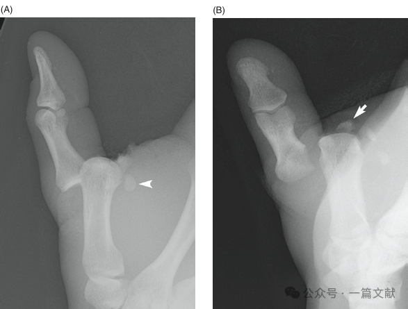 掌骨骨折、脱位影像汇总