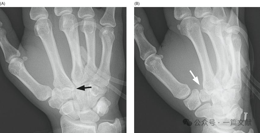 掌骨骨折、脱位影像汇总