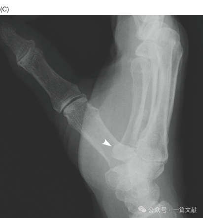 掌骨骨折、脱位影像汇总