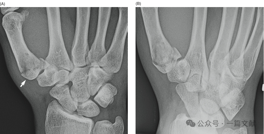 掌骨骨折、脱位影像汇总