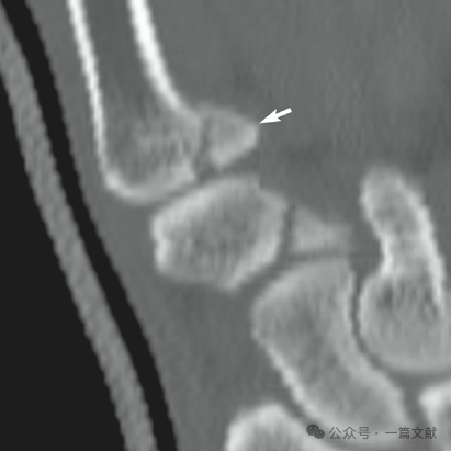 掌骨骨折、脱位影像汇总