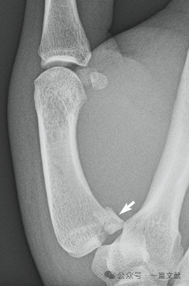 掌骨骨折、脱位影像汇总