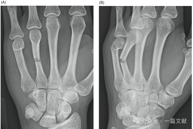 掌骨骨折、脱位影像汇总