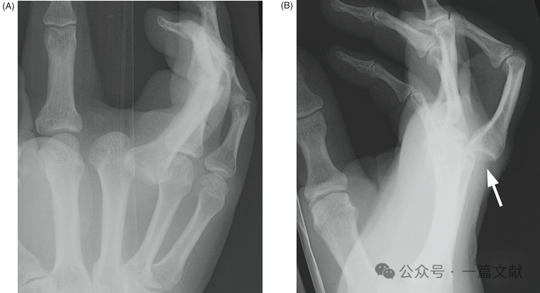 掌骨骨折、脱位影像汇总