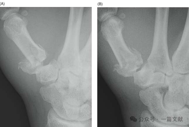 掌骨骨折、脱位影像汇总