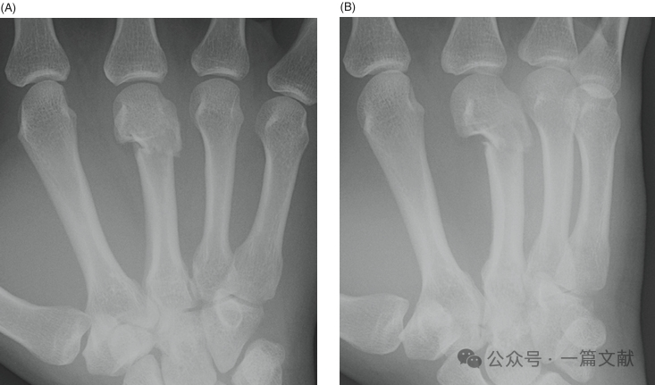 掌骨骨折、脱位影像汇总