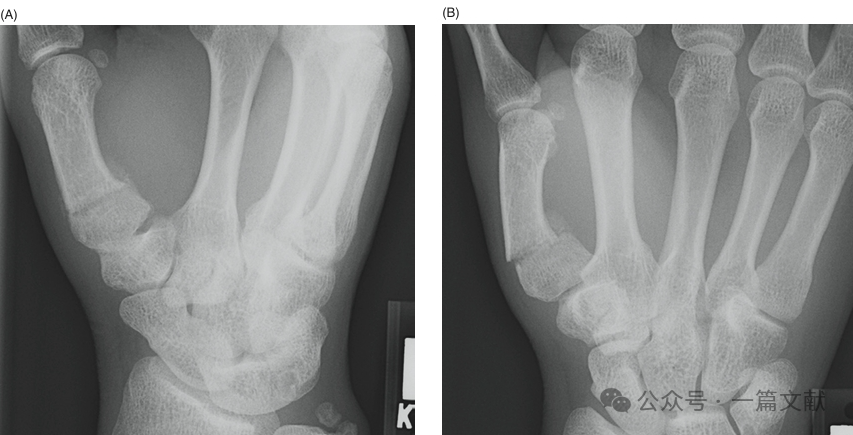 掌骨骨折、脱位影像汇总