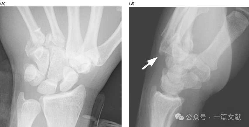掌骨骨折、脱位影像汇总