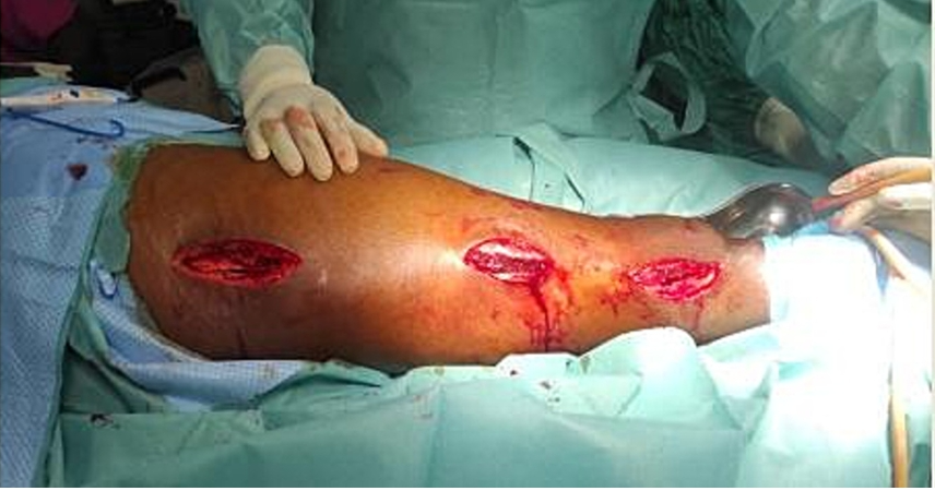 微创双钢板桥接固定治疗复杂股骨骨折！