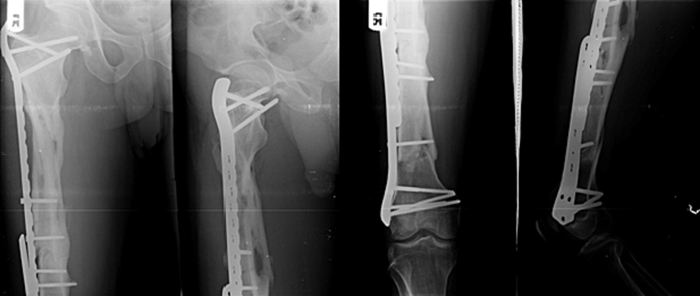 微创双钢板桥接固定治疗复杂股骨骨折！