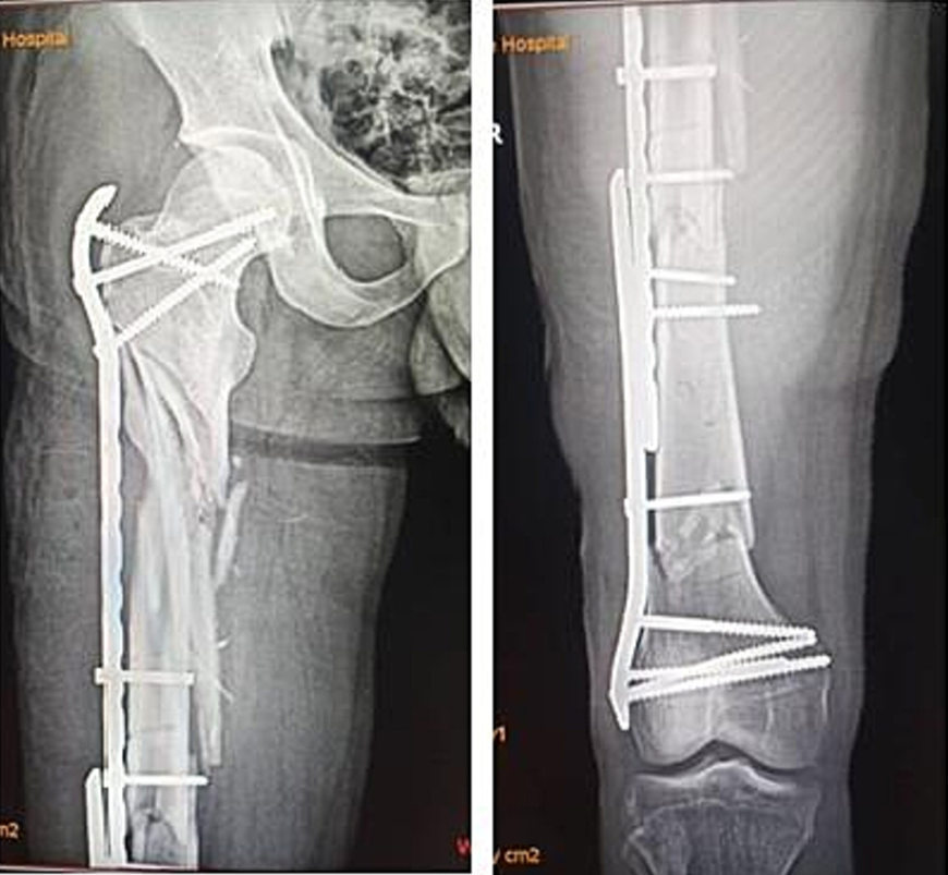 微创双钢板桥接固定治疗复杂股骨骨折！